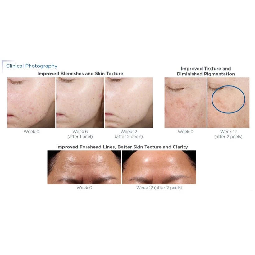 Neostrata Prosystem Retinol Peel