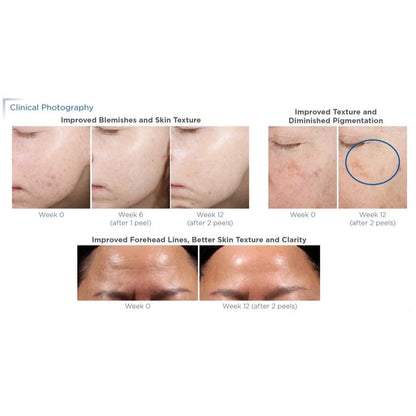 Neostrata Prosystem Retinol Peel