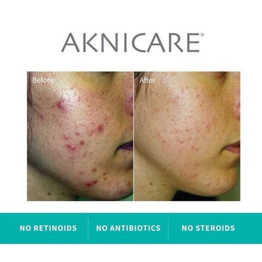 Aknicare Fast Creamgel