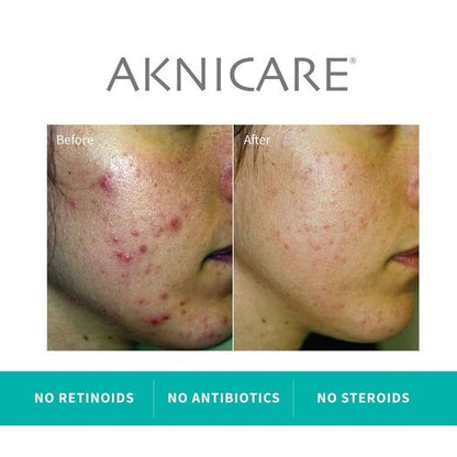 Aknicare Cream
